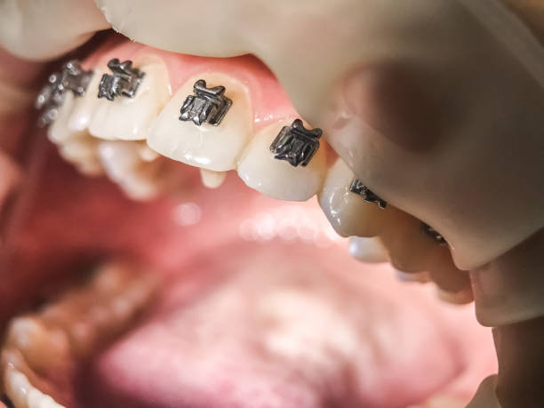 istock Mouth with brackets braces in medical concept 1251957598