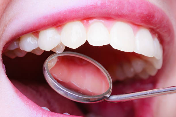 istock Woman teeth and dentist mouth mirror 1252394033