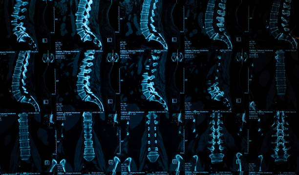 요추의 mri 스캔. mri는 척추의 퇴행성 변화, 요추 디스크의 탈장 및 신경 뿌리의 압축을 보여줍니다. - human spine mri scan x ray doctor 뉴스 사진 이미지