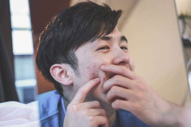 istock Asian man got an Acne 1252608686
