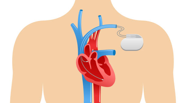 herzschrittmacher-anatomisches schema - herzschrittmacher stock-grafiken, -clipart, -cartoons und -symbole