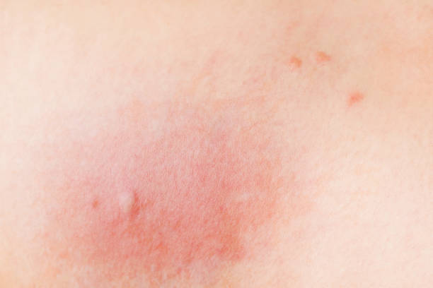 피부 질감, 벌레에 대한 알레르기, 발적, 붓기. 피부 알레르기 반응 - horse fly 뉴스 사진 이미지