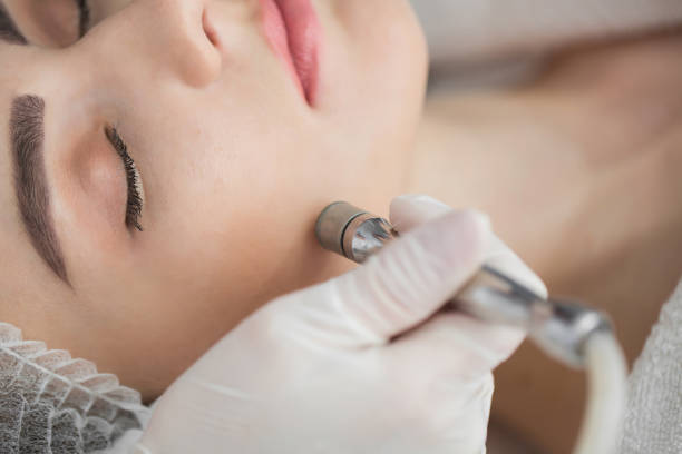 Diamond microdermabrasion, peeling cosmetic. woman during a microdermabrasion treatment in beauty salon Diamond microdermabrasion, peeling cosmetic. woman during a microdermabrasion treatment in beauty salon microdermabrasion stock pictures, royalty-free photos & images