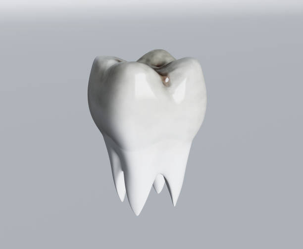 istock Cavities of molar tooth, tooth decay, caries. 3d illustration 1252775148