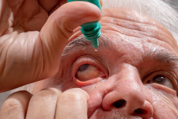 istock Elderly man buries medicine in his eyes 1252830370