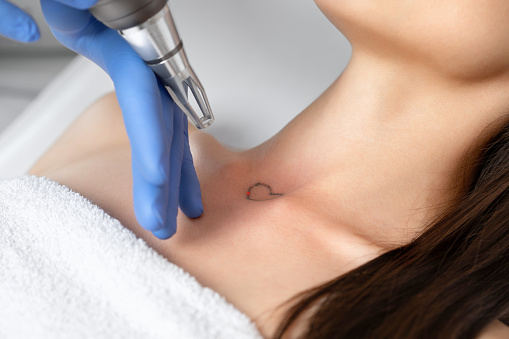 El médico esteticista hace la eliminación de tatuajes con láser en el cuello de una joven morena en el salón. Cosmetología estética, tratamiento de la piel y eliminación de tatuajes. photo
