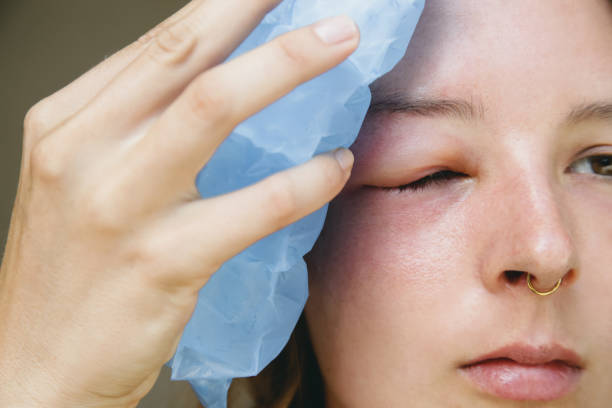 Young caucasian woman with a swollen eye from a wasp's sting. Allergy reaction on wasp bite. Young caucasian woman with a swollen eye from a wasp's sting. Allergy reaction on wasp bite. woman darts stock pictures, royalty-free photos & images