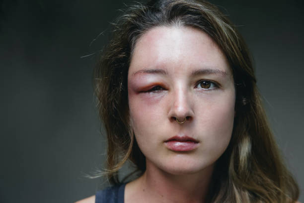 Young caucasian woman with a swollen eye from a wasp's sting. Allergy reaction on wasp bite. Young caucasian woman with a swollen eye from a wasp's sting. Allergy reaction on wasp bite. swollen stock pictures, royalty-free photos & images