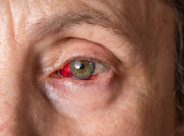 Close up of senior womans eye with conjunctivitis or pink eye around the iris Macro close image of a female eye with deep red coloration due to conjunctivitis or pink eye cornea photos stock pictures, royalty-free photos & images