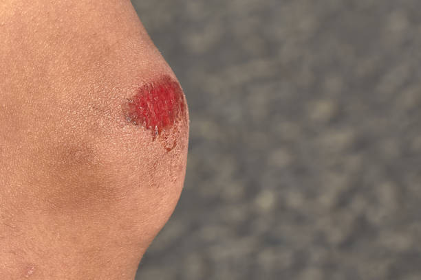 istock bruised wound on the knee, the boy fell and scratched his knee 1252964769
