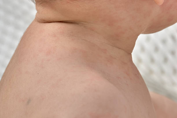 roseola rash a viral rash on the skin of a child roseola rash a viral rash on the skin of a child. roseola rash stock pictures, royalty-free photos & images