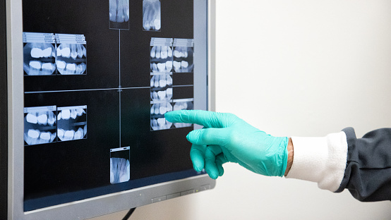 Close-Up Shot of a Dentist Wearing Surgical Gloves Pointing to an X-Ray of Teeth on a Computer Screen in a Dental Clinic
