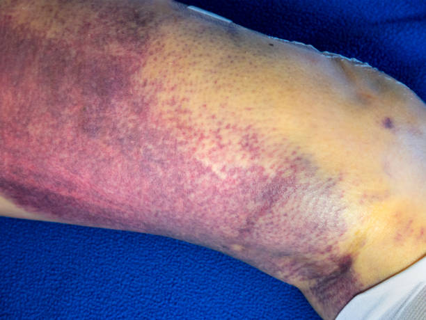 istock Senior woman's bruised leg with TED stocking after partial knee replacement surgery 1253492195