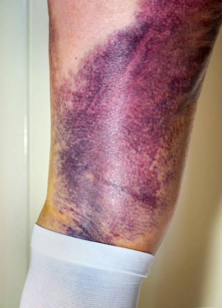 Senior woman's leg with bruises and TED stocking post surgery Badly bruised skin on the back of a senior woman’s thigh with red, brown, yellow and purple discolouration following knee surgery. Part of a TED anti-embolism stocking worn to minimise the risk of blood clots can be seen below the knee. knee contusion bruised knee stock pictures, royalty-free photos & images