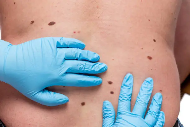 Dermatologist looking ar birthmark on patient