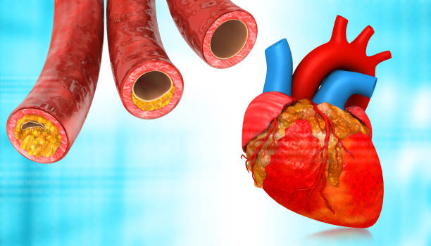 Human heart with clogged arteries Human heart with clogged arteries. 3d illustration cholesterol stock pictures, royalty-free photos & images