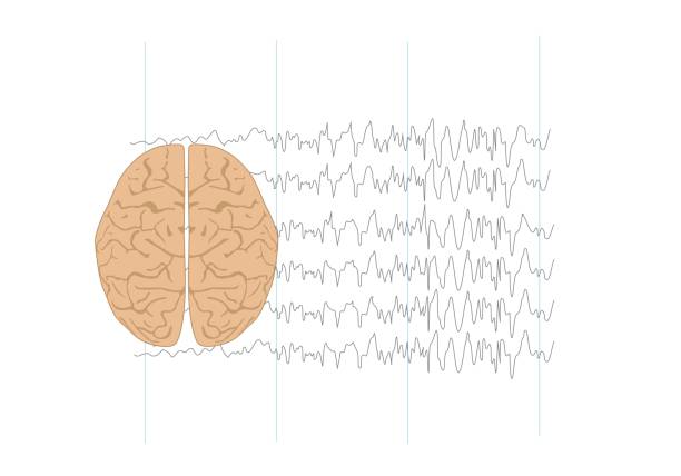 illustrazioni stock, clip art, cartoni animati e icone di tendenza di illustrazione del cervello umano e delle onde cerebrali anomale - eeg epilepsy science electrode