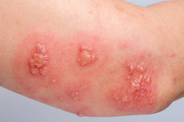 istock Shingles, Zoster or Herpes Zoster symptoms on arm 1253850033