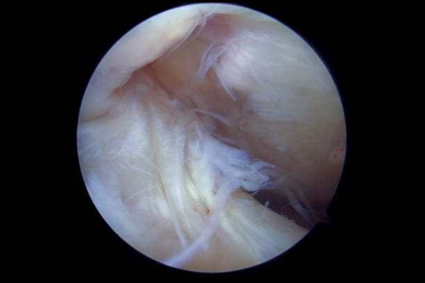 Arthroscopic view of partly torn anterior cruciate ligament due to impingement from bone spurs caused by osteoarthritis of the right knee Arthroscopic view of partly torn anterior cruciate ligament (ACL) due to impingement (compression and friction) from osteophytes (bone spurs) on the femoral condyles surrounding the intercondylar notch (or intercondylar fossa) caused by osteoarthritis of the right knee. The impingement occurs with the knee in extension. The impingement may be surgically treated by a notchplasty where bone spurs are removed and the intercondylar notch enlarged by the use of a burr. The ACL is seen in the center of the image with longitudinal tears and scuffed surface. Bone spurs are seen at the edges of the lateral femoral condyle to the left and the medial femoral condyle to the right. The image was captured with a 30 degrees 4mm arthroscope placed in the intercondylar space with the knee flexed to about 30 degrees. human tissue stock pictures, royalty-free photos & images