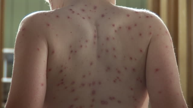 Chicken pox / spots & rash - HD