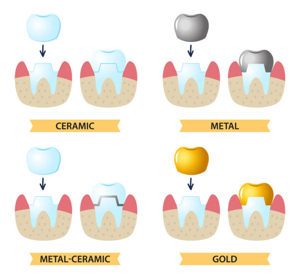 Icons on the dental Theme. Service installation of a ceramic crown. Icons on the dental Theme. Service installation of a ceramic crown. As well as a metal and gold crown on the tooth. Set icons flat style. dental gold crown stock illustrations