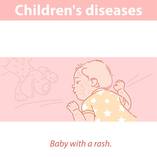 Little baby with rash on face and body. Sick baby sleeping. Child feeling bad. Children diseases. Symptoms of chicken pox,rubella, measles. Boy or girl of one year ill. Color vector illustration. measles illustrations stock illustrations