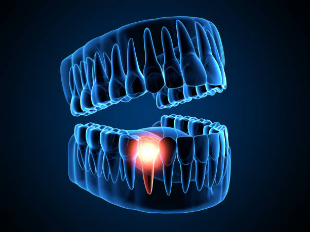 istock 3d render of  jaw x-ray with aching tooth 1254343539
