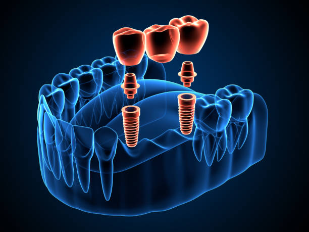 3d render de rayos x de mandíbula con implantes apoyado puente dental - corona-dental fotografías e imágenes de stock