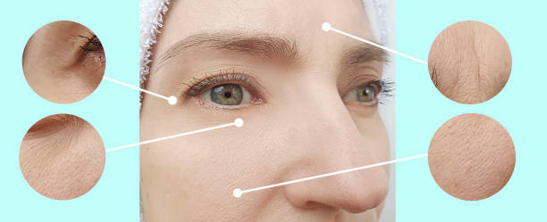 istock woman face wrinkles before and after collage treatment 1254373775