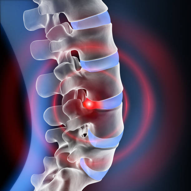 istock Spinal cord under pressure of intervertebral disc 1254386440