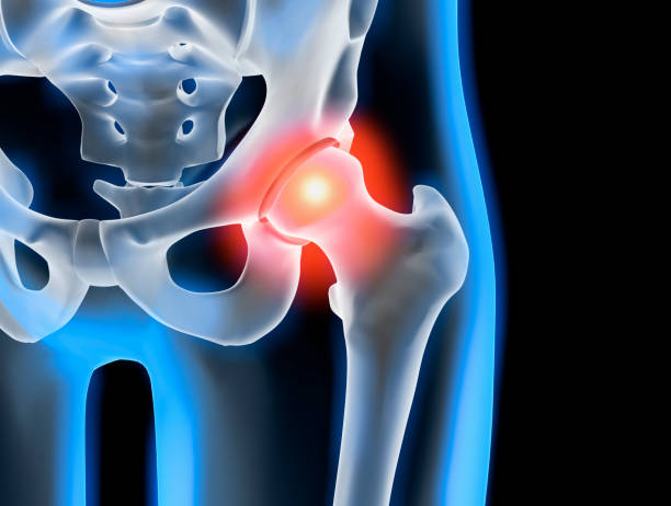 Painful hip joint - x-ray illustration Hip joint inflammation with pain symptom - 3D Rendering hip body part stock pictures, royalty-free photos & images