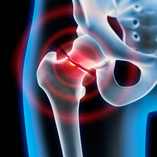 istock Painful broken hip joint - x-ray illustration 1254388862