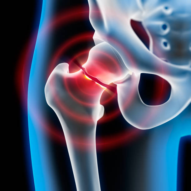 Painful broken hip joint - x-ray illustration Broken hip joint with pain symptom - 3D Rendering bone fracture stock pictures, royalty-free photos & images