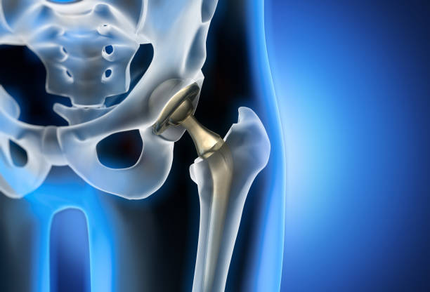 X-ray illustration of hip replacement 3d rendering of total hip replacement - medical illustration hip replacement stock pictures, royalty-free photos & images
