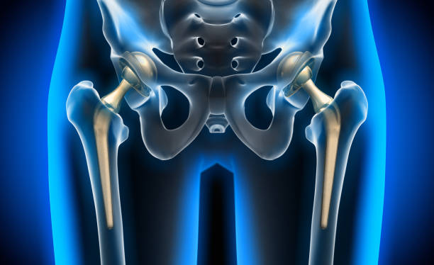 röntgenbild des hüftersatzes - hip replacement stock-fotos und bilder