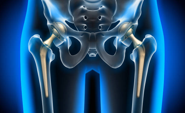 X-ray illustration of hip replacement 3d rendering of total hip replacement - medical illustration hip replacement stock pictures, royalty-free photos & images