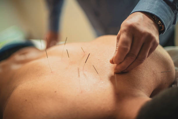 Back acupuncture stock photo