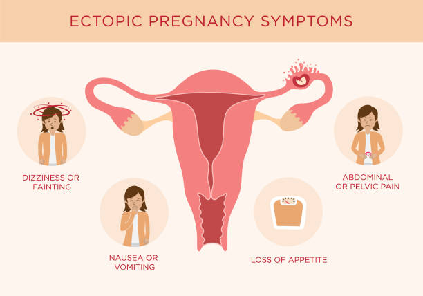 50+ Ectopic Pregnancy Stock Illustrations, Royalty-Free Vector Graphics &  Clip Art - iStock