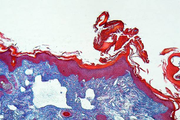 istock Human skin with a Scabies infection, Sarcoptes scabiei, under the microscope 1254441846