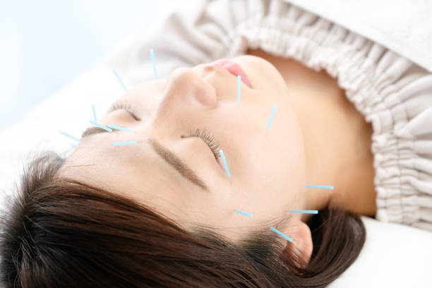 up of a woman getting acupuncture on her face at an acupuncture clinic - massaging alternative medicine headache women imagens e fotografias de stock