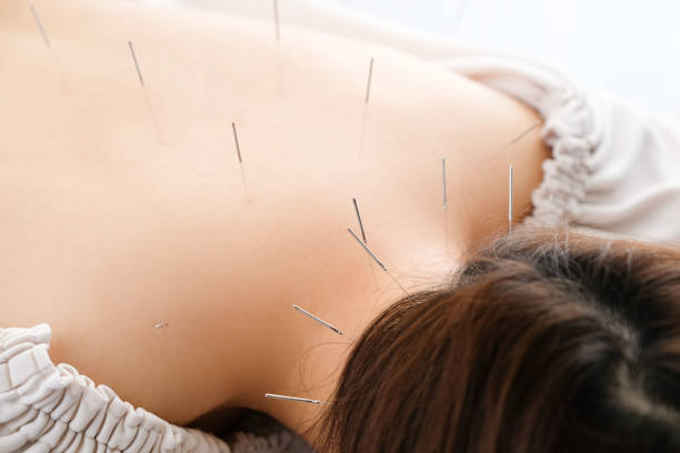 una mujer con una aguja pegada a su espalda en una clínica de acupuntura brillante - acupuntura cuello fotografías e imágenes de stock