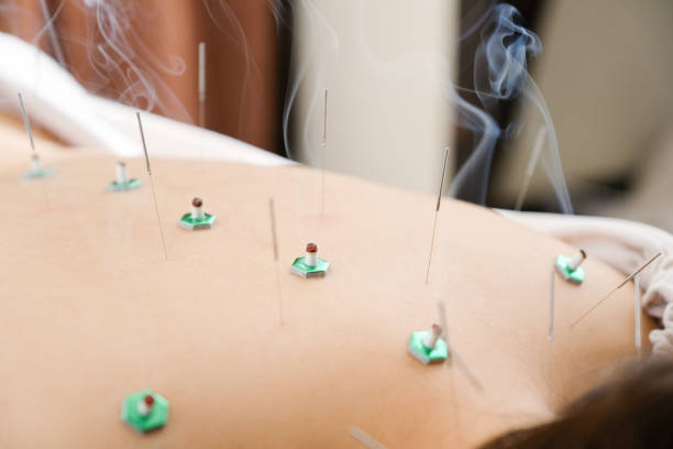 A woman with a needle stuck to her back at a bright acupuncture clinic A woman with a needle stuck to her back at a bright acupuncture clinic pressure point photos stock pictures, royalty-free photos & images