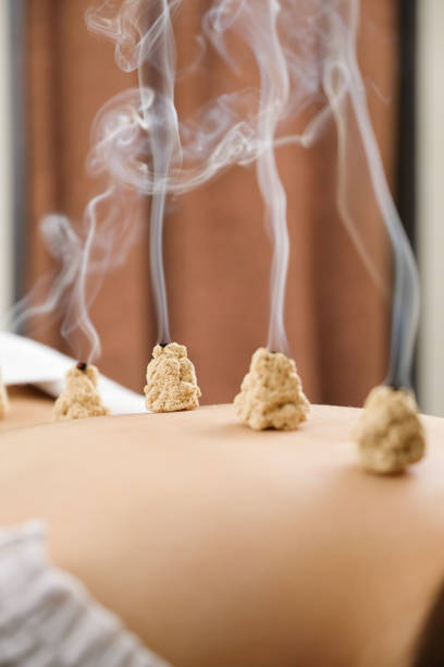 Acupuncture and moxibustion on the back of a woman in a bright acupuncture center Acupuncture and moxibustion on the back of a woman in a bright acupuncture center acupuncture model stock pictures, royalty-free photos & images