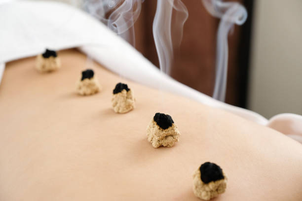 Acupuncture and moxibustion on the back of a woman in a bright acupuncture center Acupuncture and moxibustion on the back of a woman in a bright acupuncture center acupuncture model stock pictures, royalty-free photos & images