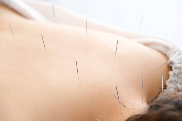 une femme avec une aiguille collée à son dos à une clinique lumineuse d’acupuncture - acupuncture needle photos et images de collection