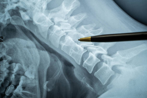의사는 경막외 마취 또는 척추 천자 행동의 절차인 척추 사이의 척추에 ct mri 스캔 장소를 보여줍니다. 출산 또는 신경 외과 수술 중 경막외 마취 - human spine mri scan x ray doctor 뉴스 사진 이미지