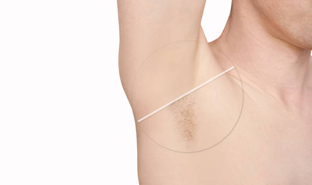 istock Girl underarm. White man armpit. Before and after epilation. 1254512718