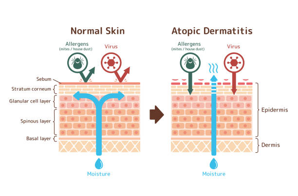 Sectional view of atopic dermatitis and normal skin / Comparative vector illustration Sectional view of atopic dermatitis and normal skin / Comparative vector illustration epidermal cell stock illustrations