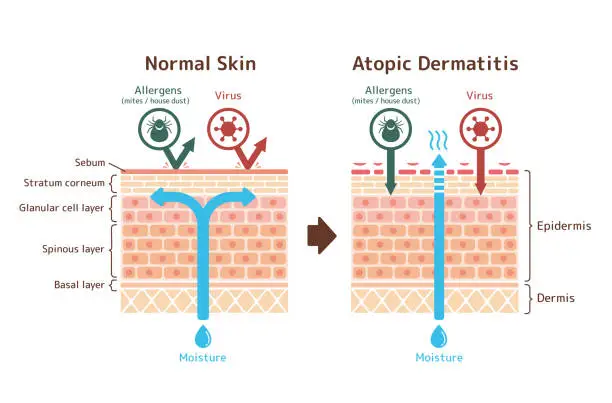 Vector illustration of Sectional view of atopic dermatitis and normal skin / Comparative vector illustration