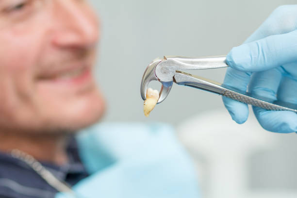стоматолог извлек больной зуб у пациента в стоматологическом кабинете - extracted стоковые фото и изображения